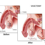 vasectomy 2
