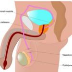 vasectomy 3