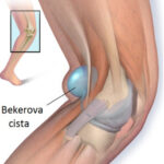 bakerova cista