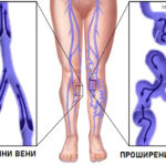 просирени вени