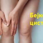 Бејкерова циста