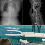 FET-Frozen-Elephant- trunk-Zan-Mitrev-Klinika