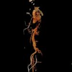 Frozen Elephant trunk – FET (2)