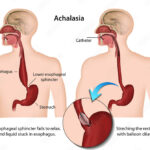 achalasia