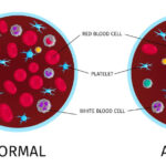 anemia