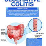colitis