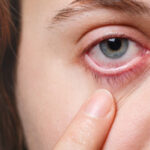 konjuktivitis