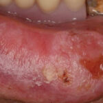 lip rak