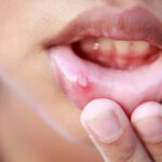 oral cancer