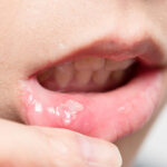 oral cancer 3