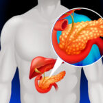 pancreas 34
