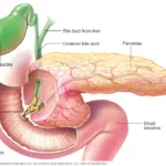 pankreatitis