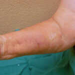 Nephrogenic systemic fibrosis