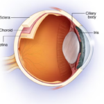 uveitis
