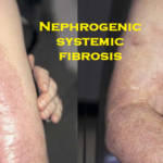 Nephrogenic systemic fibrosis