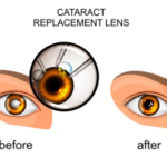 cataracta 1