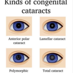 cataracta 3