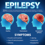 epilepsija