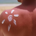sun alergy