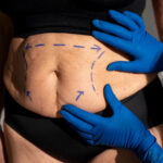 liposukcija