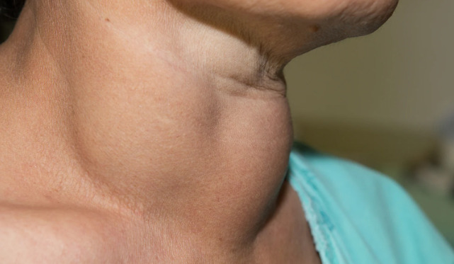 Гушавост или струма-неправилен раст на тироидната жлезда