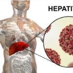 hepatit b