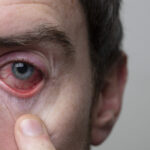 Close up of a severe bloodshot eye. Blepharitis, Conjunctivitis condition