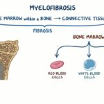 myelofibrosa