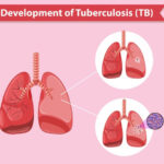 razvoj na TB
