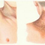 Acanthosis_nigricans