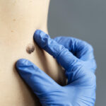 close-up-hand-with-glove-measuring-mole