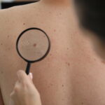 Dermatologist doctor examines birthmark of patient on back with magnifying glass