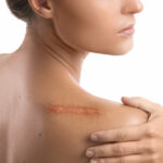 Woman with a scar on her shoulder