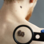young-man-with-moles-back-back-view