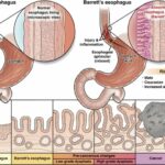 CGH-PatientEd-Barretts-2020-min-768×520