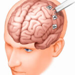 brain suregery