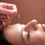 Acupuncture