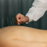 Acupuncture