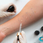 Allergy skin tests