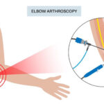 Arthroscopy