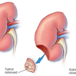 Отстранување на бубрег
