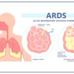 acute-respiratory-distress-syndrome-overview