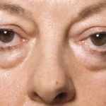 Thyroid Eye Disease