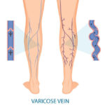 varicose veins