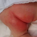 diaper-rash-in-newborns-e1588673656618