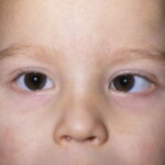 m1550494-strabismus-esotropia-science-photo-library-high