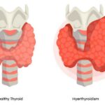 tiroidna (3)