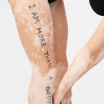 vitiligo