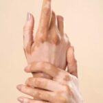vitiligo