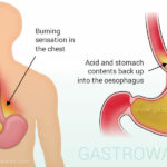 stomach-dyspepsia